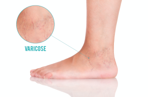 Varicose veins