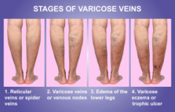 vein-issues-fort-myers-eveinscreening-300x191