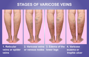 vein issues fort myers eveinscreening